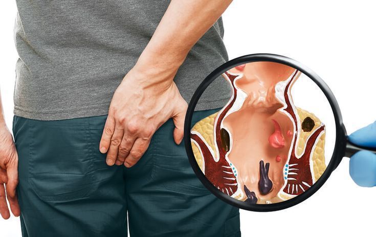 Hemorrhoid treatment information