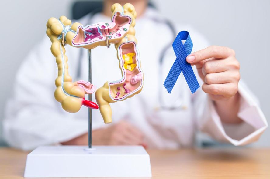 Colon cancer early signs