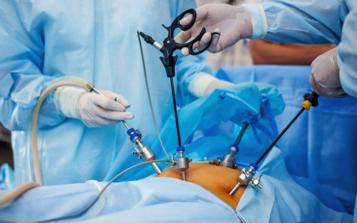 Laparoscopic Surgery