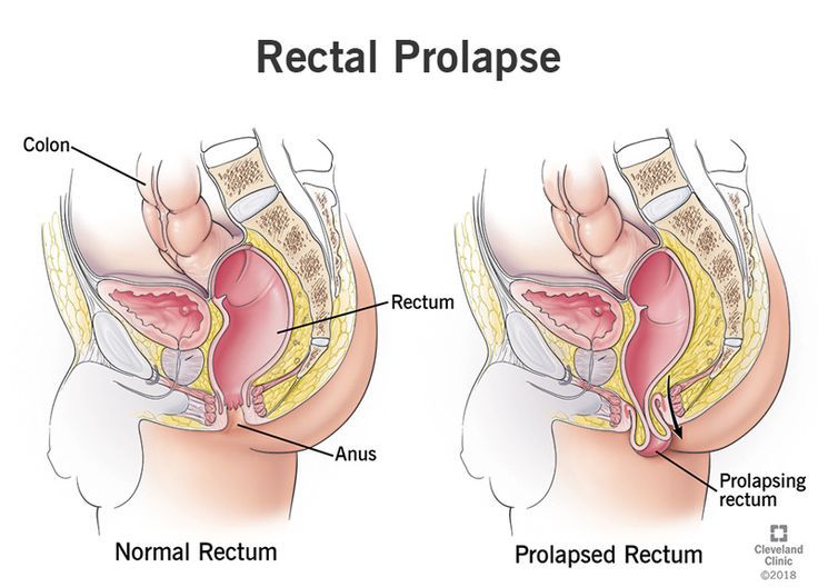 Rectal Prolapse Surgery